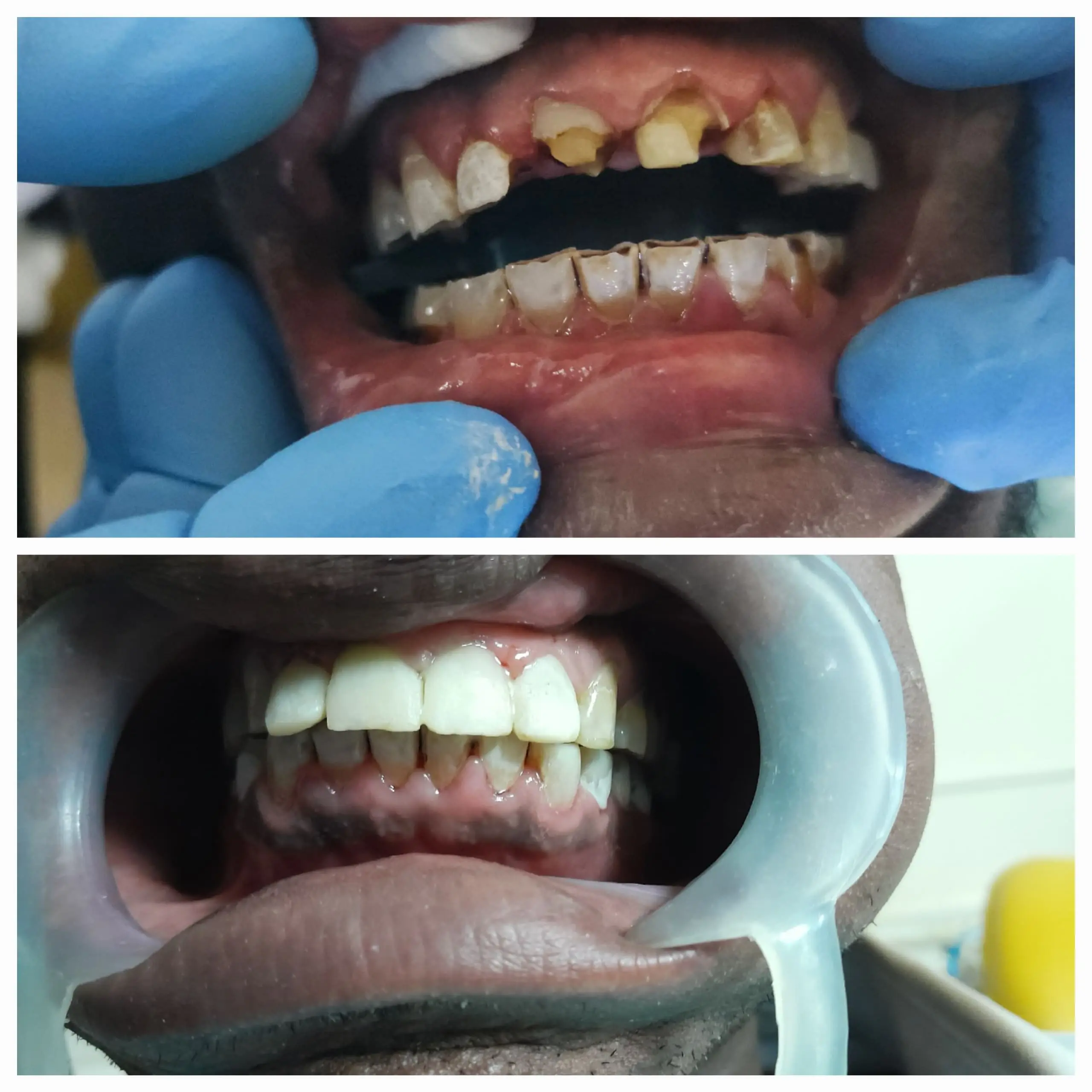 Fillings done at Sterling Dental Clinic